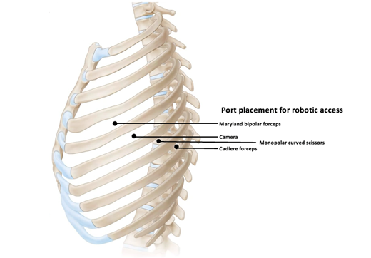 Left robotic assisted thoracic surgery (RATS) stellate ganglion ...