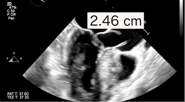 Robotic Endoscopic Transmitral Septal Myectomy And Concomitant Mitral Valve Repair For