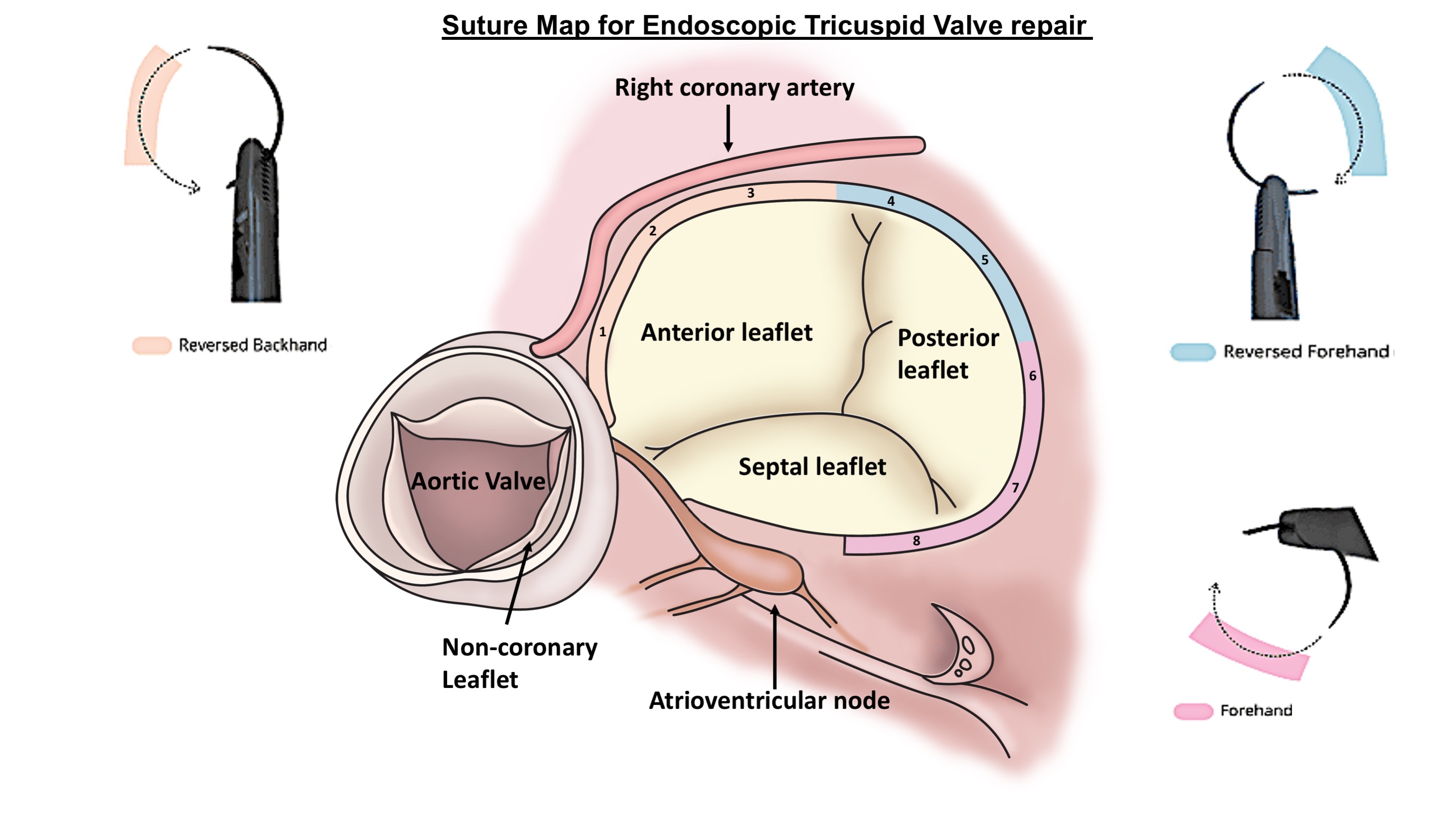 tricuspid valve