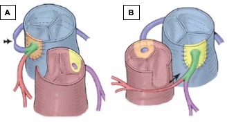 Coronary transfer for complex looping and intramural variants in the ...