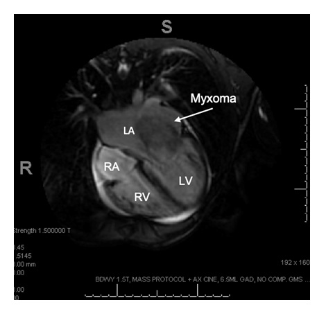 La Myxoma