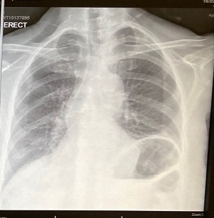 Right robotic-assisted hybrid diaphragm plication | MMCTS